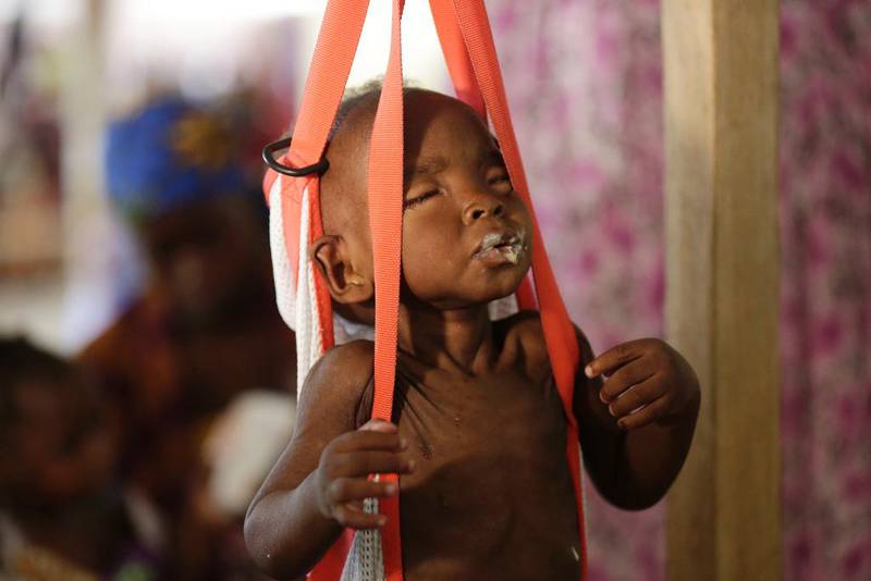 Sult: Denne underernærte gutten er et offer for Boko Harams herjinger i Nigeria, men får behandling av Leger Uten Grenser. 80.000 barn i Nigeria risikerer å dø av sult hvis de ikke får hjelp, advarer Unicef.
