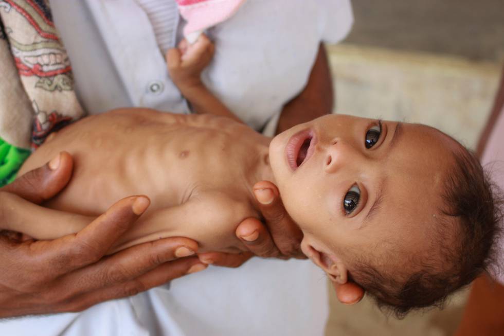 In this Sunday, June 14, 2020 photo, seven-month-old Issa Ibrahim Nasser is brought to a clinic in Deir Al-Hassi, At seven months old, Issa weighs only three kilos. Like him, hundreds of children suffer from acute severe malnutrition because of poverty and grinding conflict. Yemen. (AP Photo/Issa Al-Rajhi)