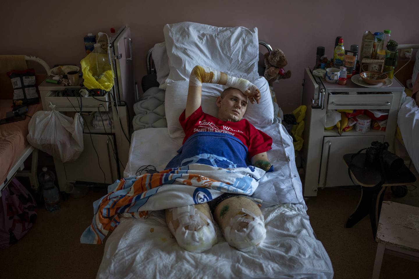 Anton Gladun, 22, lies on his bed at the Third City Hospital, in Cherkasy, Ukraine, Thursday, May 5, 2022. Anton, a military medic deployed on the front lines in eastern Ukraine, lost both legs and the left arm due to a mine explosion on March 27. (AP Photo/Emilio Morenatti)