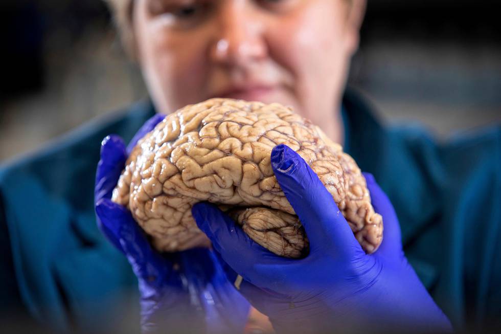 In this Aug. 14, 2019 photo provided by the University of Kentucky, Donna Wilcock, of the Sanders-Brown Center on Aging, holds a brain in her lab in Lexington, Ky. She says that contrary to popular perception, "there are a lot of changes that happen in the aging brain that lead to dementia in addition to plaques and tangles." (Mark Cornelison/University of Kentucky via AP)