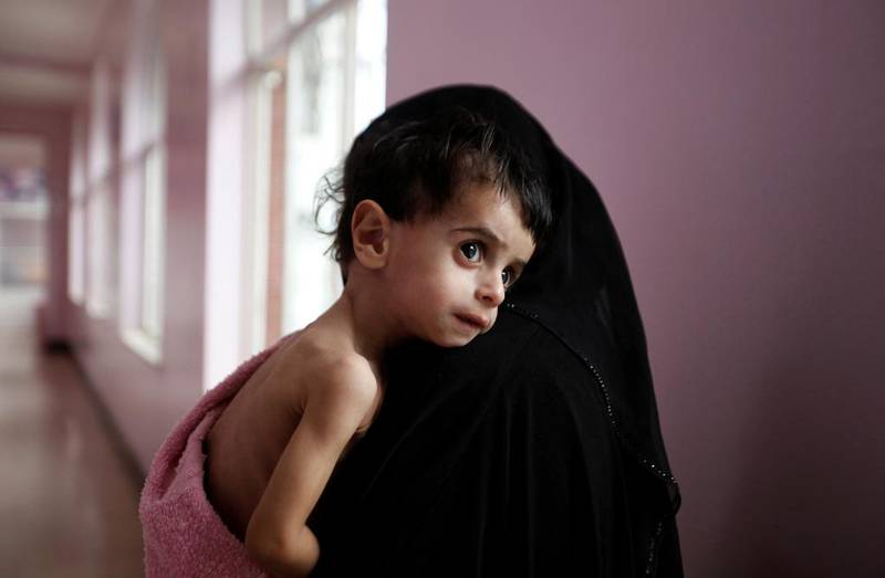 Denne underernærte gutten må bæres av moren på et sykehus i hovedstaden Sanaa i krigsherjede Jemen. Omfanget av sult har sunket med 29 prosent siden årtusenskiftet, men må gå raskere for å nå målet om null sult i 2030.