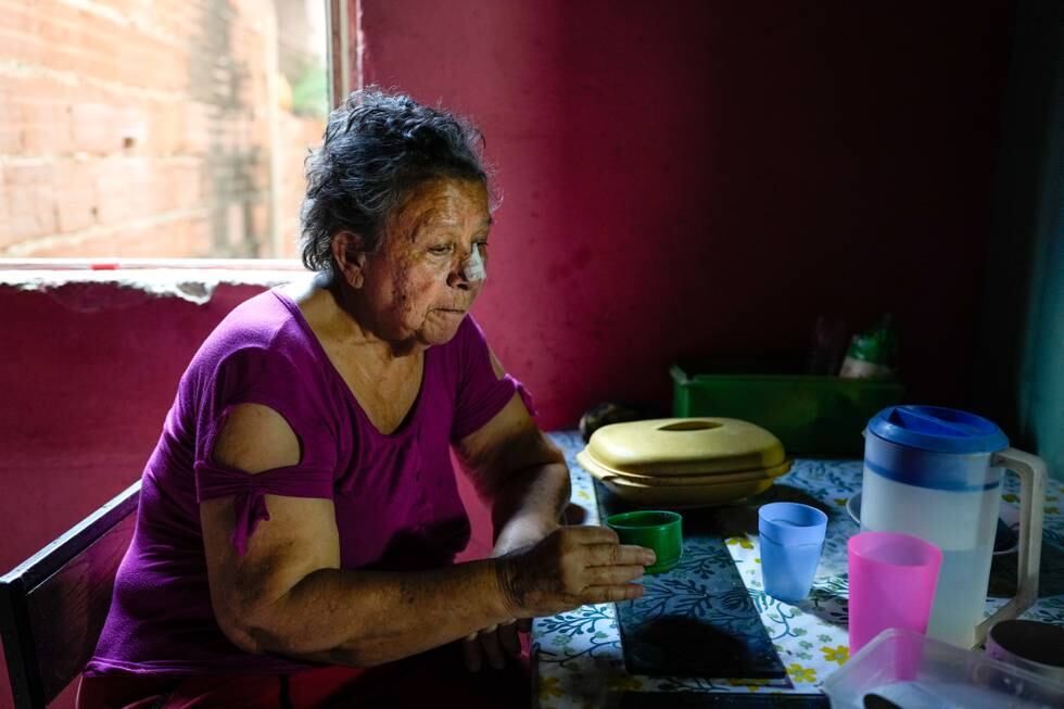 TO TYPER KREFT: Maybel Sequera drikker kaffe etter å ha spist en donert lunsj sammen med mannen sin. Sequera har blitt diagnostisert med to typer kreft i år , inkludert en type hudkreft som krevde en operasjon i ansiktet hennes. For å betale for medisinsk utstyr solgte hun to av de tre symaskinene sine.